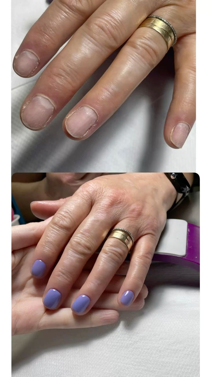 Antes e depois — Unhas fragilizadas → cor lilás com acabamento uniforme